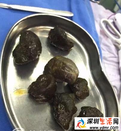 7旬大爷将柿子当饭吃肚子里结出8颗大石头