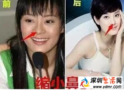 孙俪自曝整过容 整了哪些部位 隆胸需要多少钱