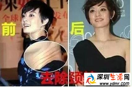 孙俪自曝整过容 整了哪些部位 隆胸需要多少钱
