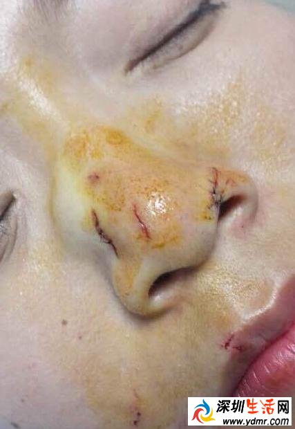 中国女游客在泰国吻蛇被咬鼻子 惊人的现场画面