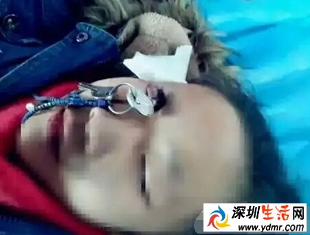 10岁女孩跌倒钥匙插入右眼 不哭反安慰妈妈