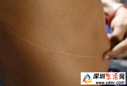 高价吸引穷人卖肾