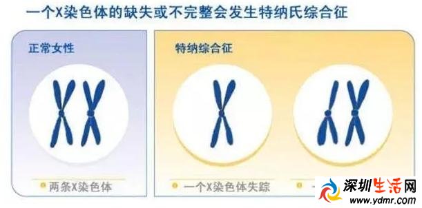 女子22岁没来过“大姨妈”怎么回事?竟是少了一条X染色体
