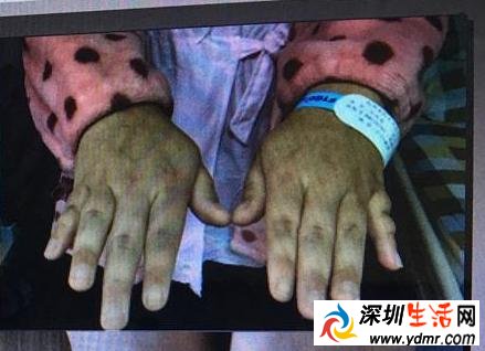 女子22岁没来过“大姨妈”怎么回事?竟是少了一条X染色体