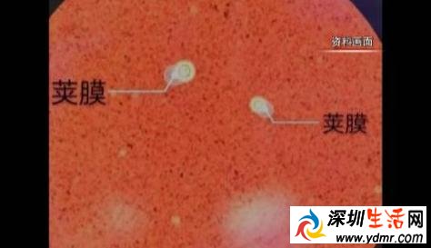 接触鸽子粪便有害吗?深圳男子得了罕见病持续头疼