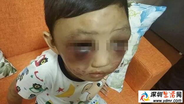 4岁男童遭母亲毒打!头肿脸青、遍体鳞伤