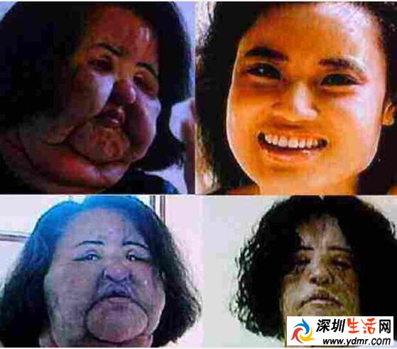 韩苗可为什么要在脸上注射食用油 往脸上注射食用油的后果