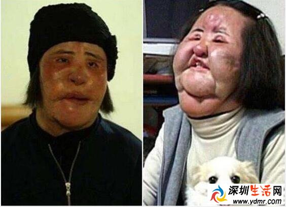 韩苗可为什么要在脸上注射食用油 往脸上注射食用油的后果