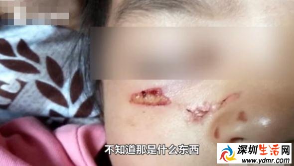 4岁女孩在父亲怀中熟睡 被天降烟头给烫伤 赔偿1万元